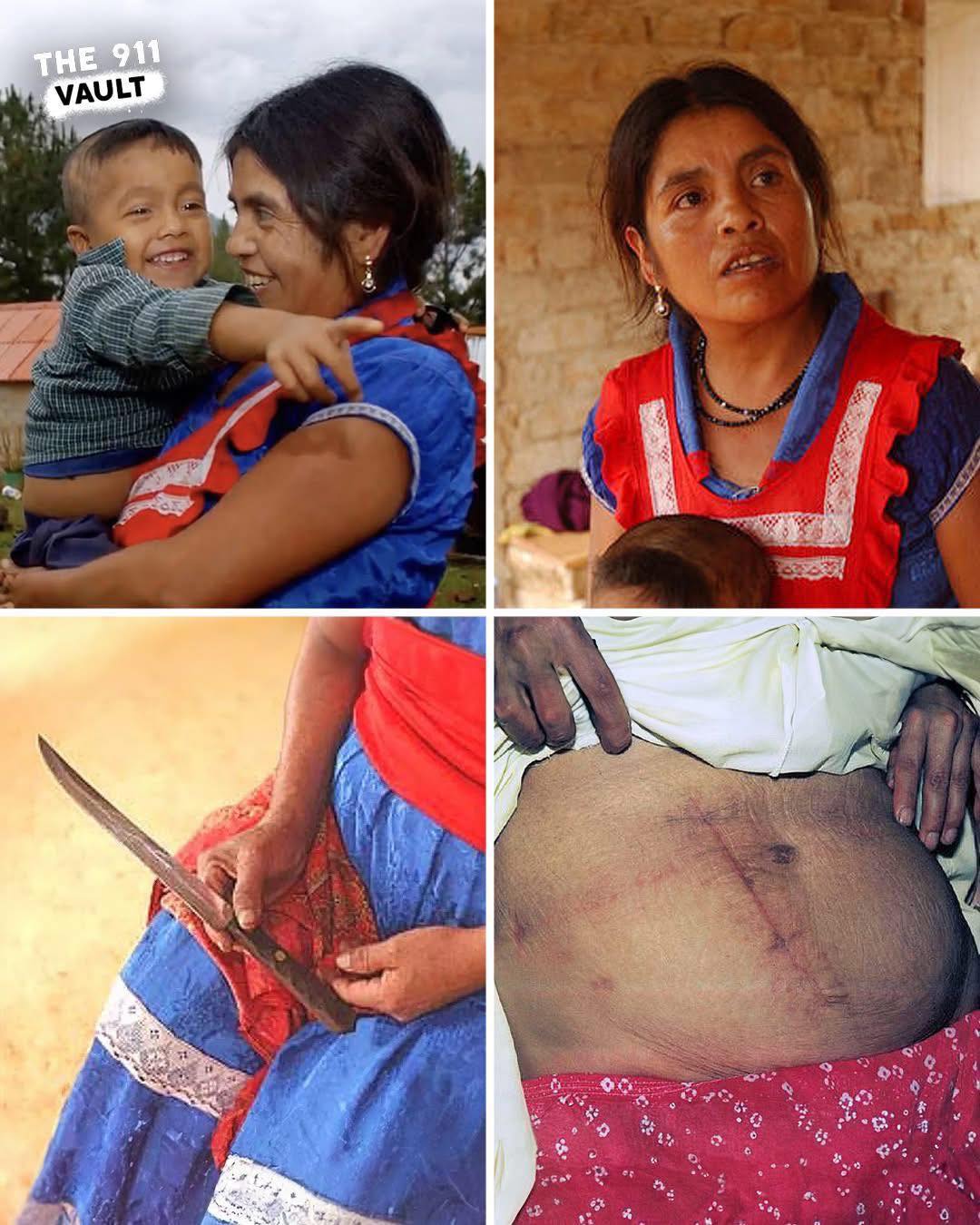 The Woman Who Performed a Cesarean Section on Herself and Survived